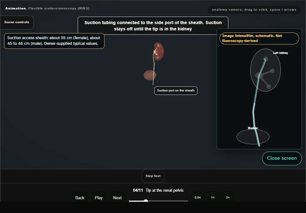 Flexible ureterorenoscopy (RIRS). Step 4: Tip at the renal pelvis. Captured frame from the interactive animation.
