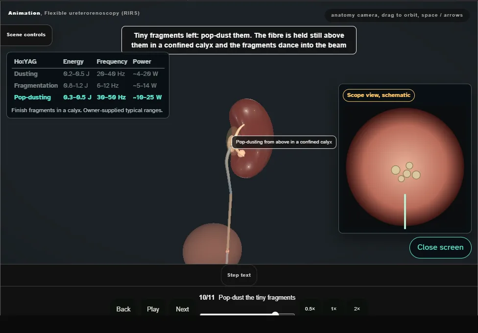 Flexible ureterorenoscopy (RIRS). Step 10: Pop-dust the tiny fragments. Captured frame from the interactive animation.