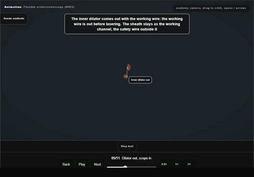 Flexible ureterorenoscopy (RIRS). Step 5: Dilator out, scope in. Captured frame from the interactive animation.