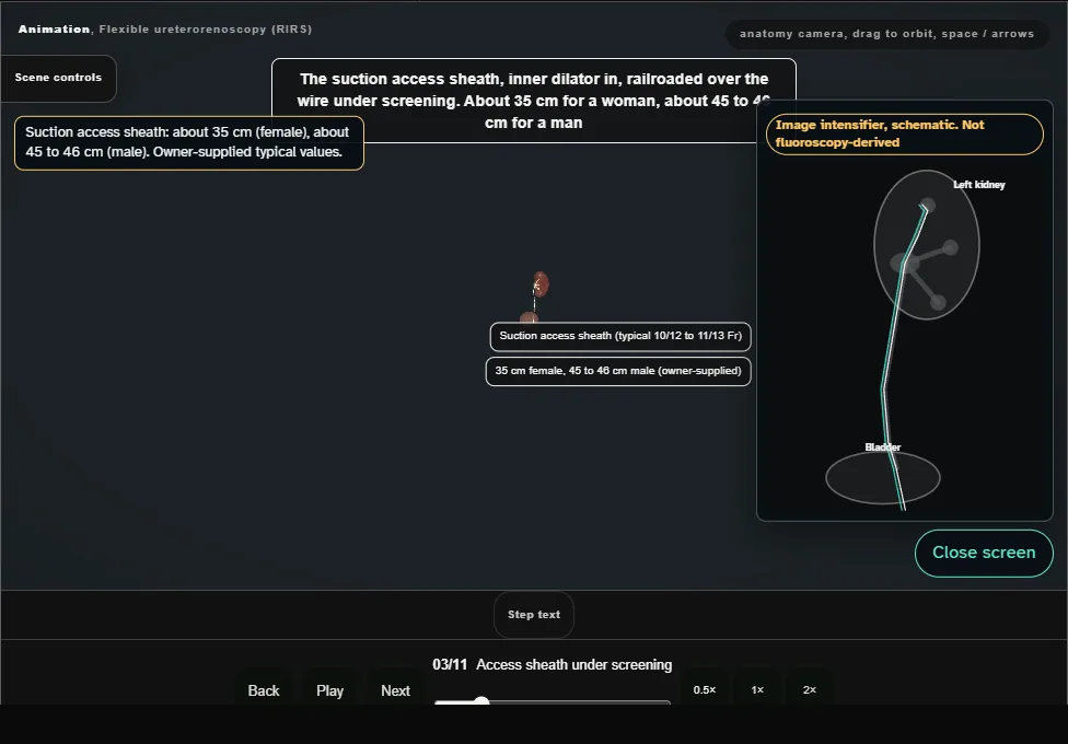 Flexible ureterorenoscopy (RIRS). Step 3: Access sheath under screening. Captured frame from the interactive animation.