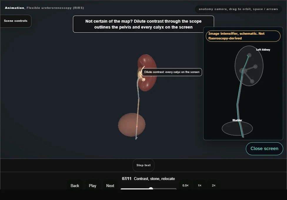 Flexible ureterorenoscopy (RIRS). Step 7: Contrast, stone, relocate. Captured frame from the interactive animation.
