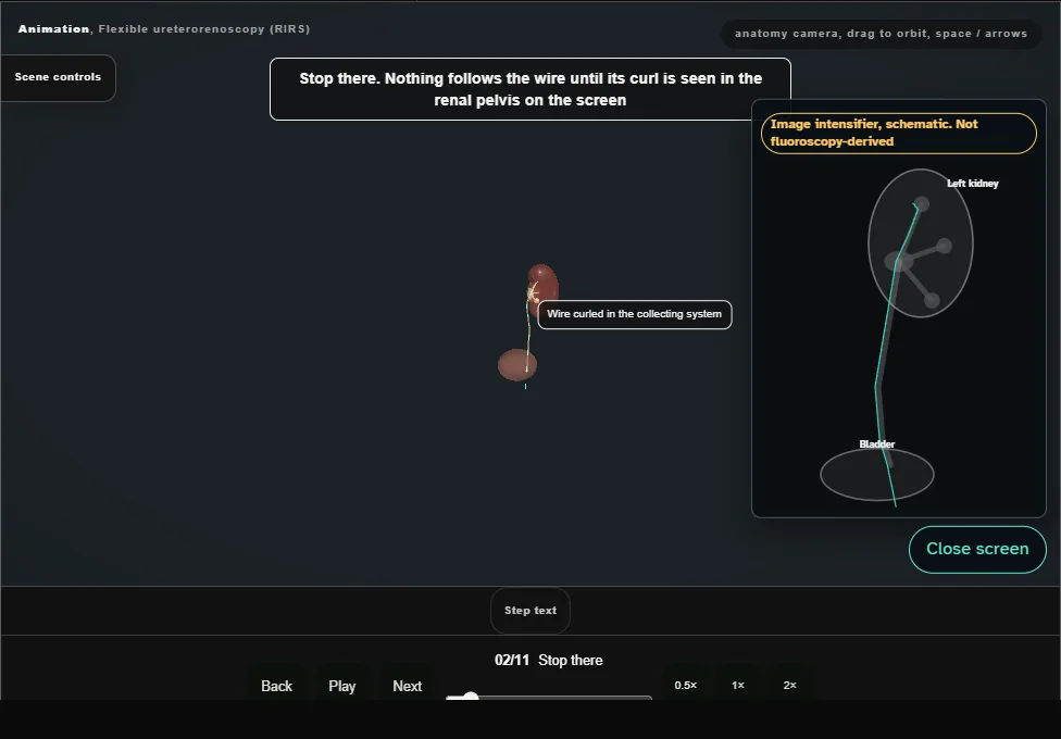 Flexible ureterorenoscopy (RIRS). Step 2: Stop there. Captured frame from the interactive animation.
