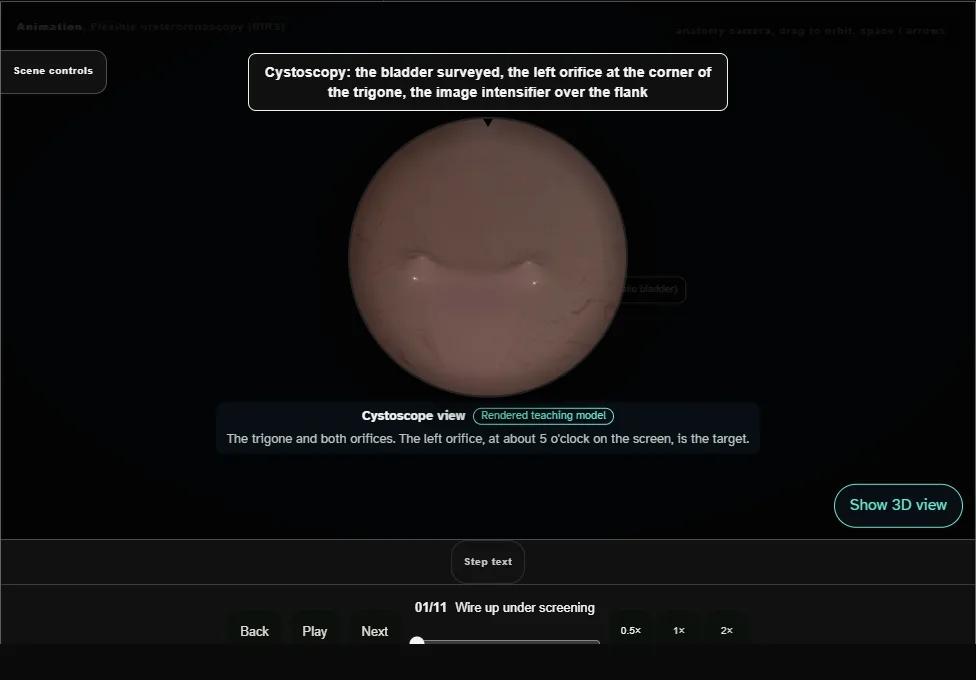 Flexible ureterorenoscopy (RIRS). Step 1: Wire up under screening. Captured frame from the interactive animation.