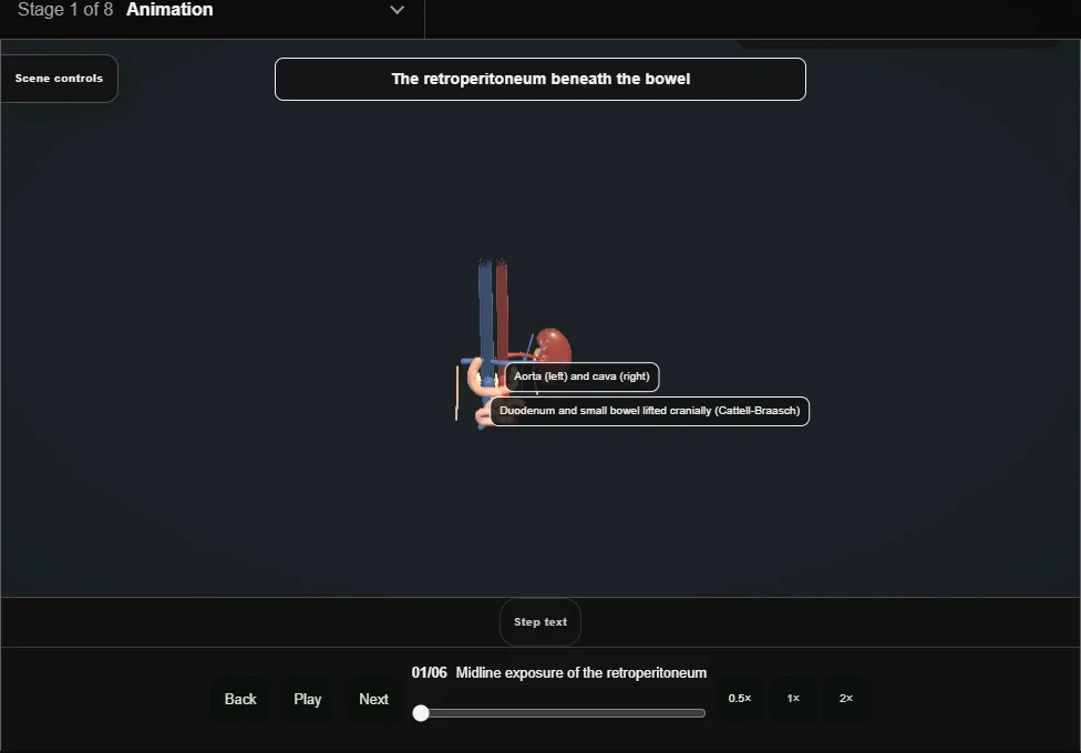 Retroperitoneal lymph node dissection. Step 1: Midline exposure of the retroperitoneum. Captured frame from the interactive animation.