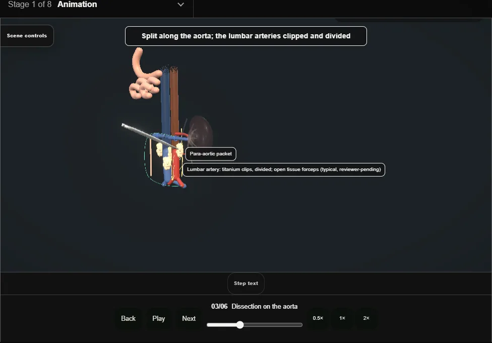 Retroperitoneal lymph node dissection. Step 3: Dissection on the aorta. Captured frame from the interactive animation.