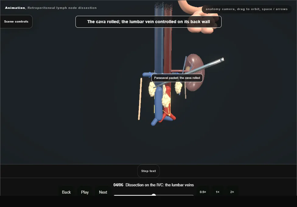 Retroperitoneal lymph node dissection. Step 4: Dissection on the IVC: the lumbar veins. Captured frame from the interactive animation.