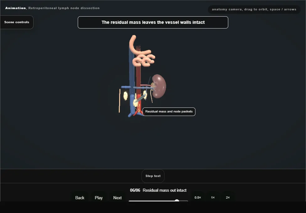 Retroperitoneal lymph node dissection. Step 6: Residual mass out intact. Captured frame from the interactive animation.