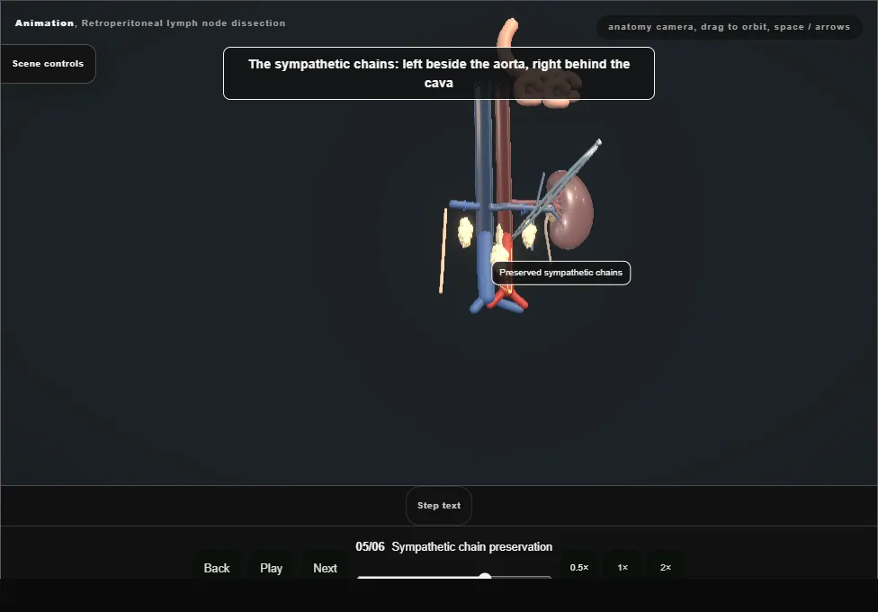 Retroperitoneal lymph node dissection. Step 5: Sympathetic chain preservation. Captured frame from the interactive animation.
