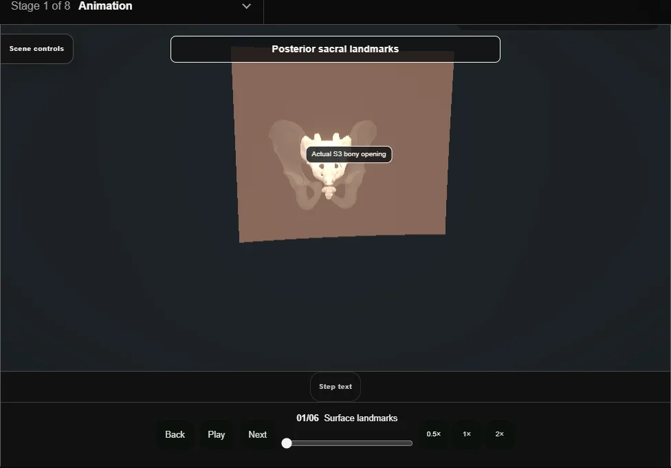 Sacral neuromodulation: S3 lead placement. Step 1: Surface landmarks. Captured frame from the interactive animation.