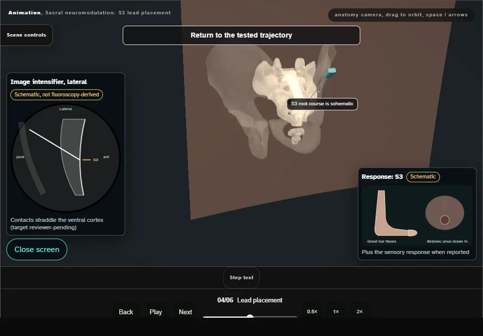 Sacral neuromodulation: S3 lead placement. Step 4: Lead placement. Captured frame from the interactive animation.