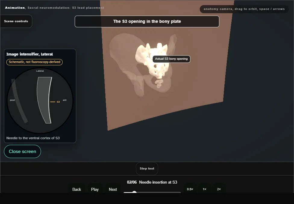 Sacral neuromodulation: S3 lead placement. Step 2: Needle insertion at S3. Captured frame from the interactive animation.