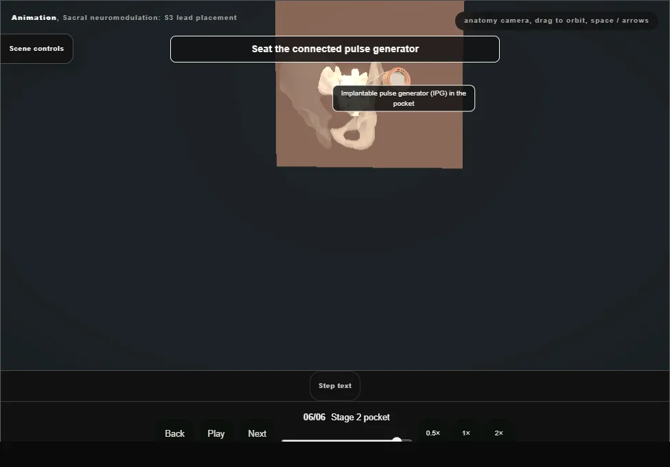Sacral neuromodulation: S3 lead placement. Step 6: Stage 2 pocket. Captured frame from the interactive animation.