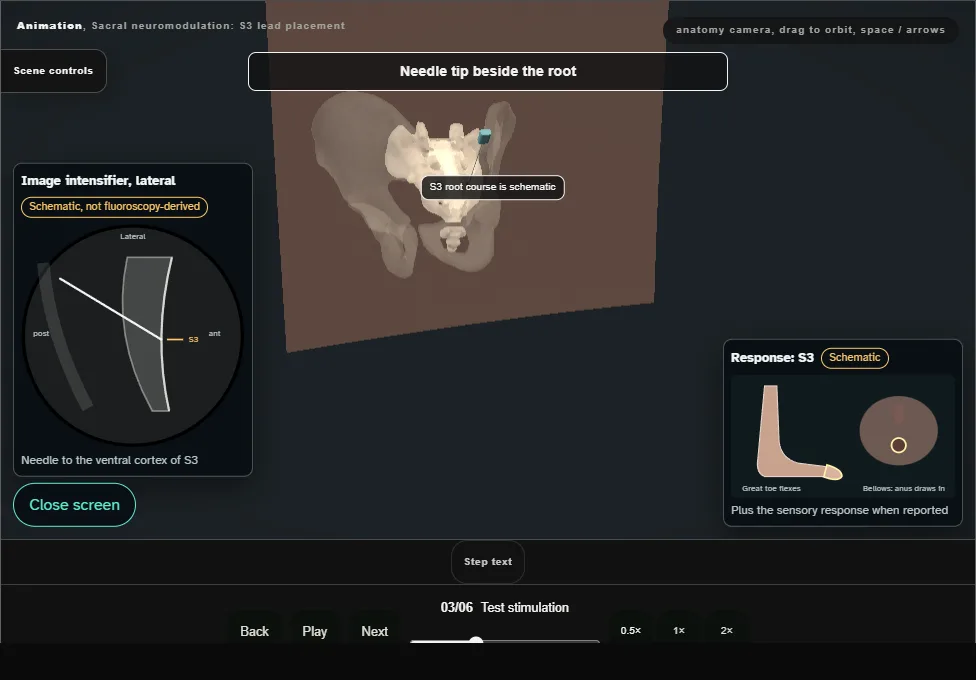 Sacral neuromodulation: S3 lead placement. Step 3: Test stimulation. Captured frame from the interactive animation.