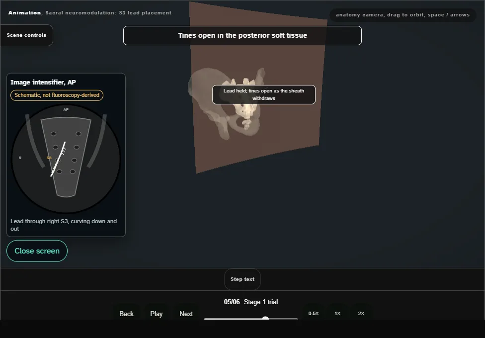 Sacral neuromodulation: S3 lead placement. Step 5: Stage 1 trial. Captured frame from the interactive animation.