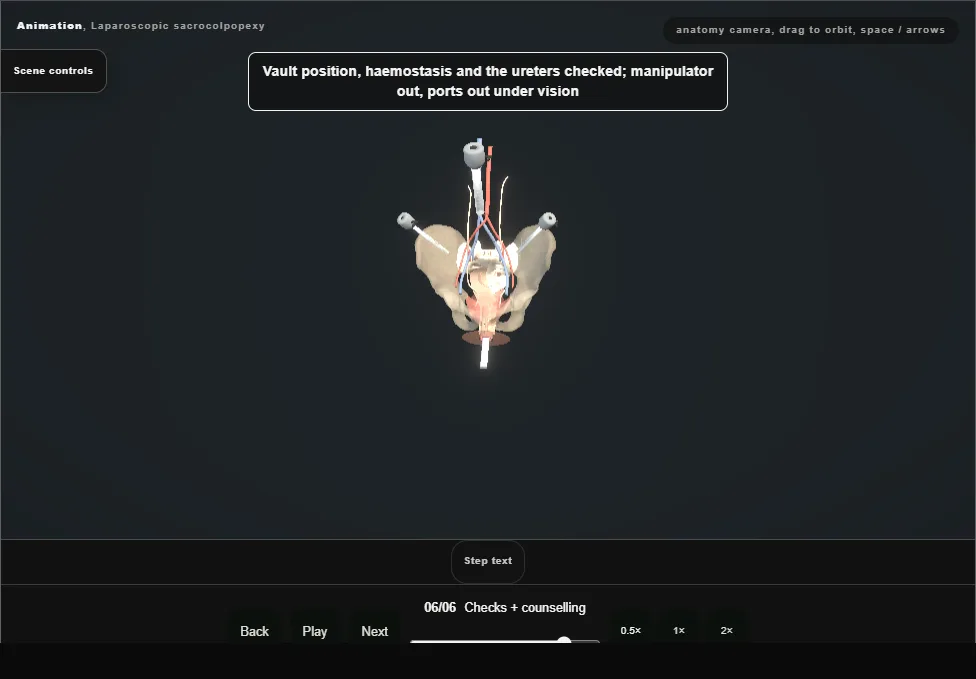 Laparoscopic sacrocolpopexy. Step 6: Checks + counselling. Captured frame from the interactive animation.
