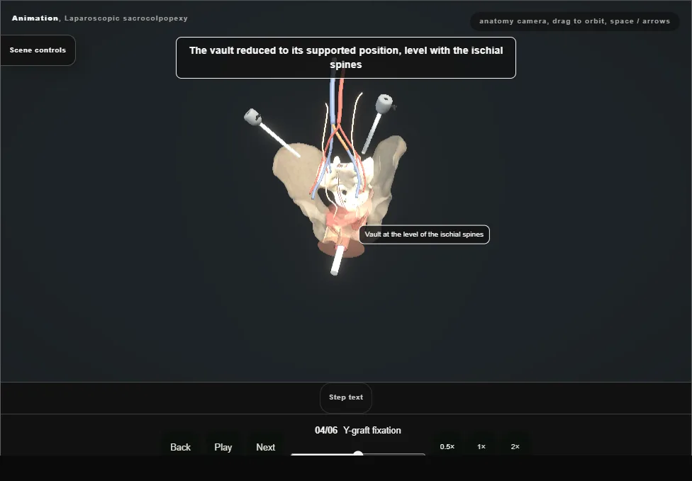 Laparoscopic sacrocolpopexy. Step 4: Y-graft fixation. Captured frame from the interactive animation.