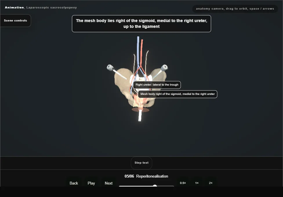 Laparoscopic sacrocolpopexy. Step 5: Reperitonealisation. Captured frame from the interactive animation.