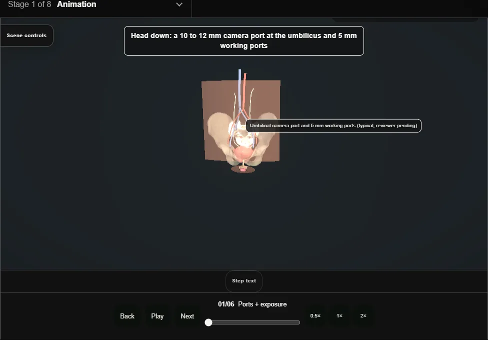 Laparoscopic sacrocolpopexy. Step 1: Ports + exposure. Captured frame from the interactive animation.