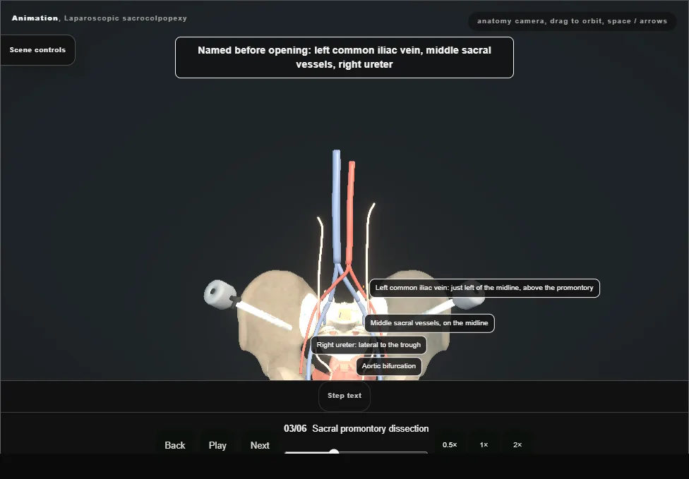 Laparoscopic sacrocolpopexy. Step 3: Sacral promontory dissection. Captured frame from the interactive animation.