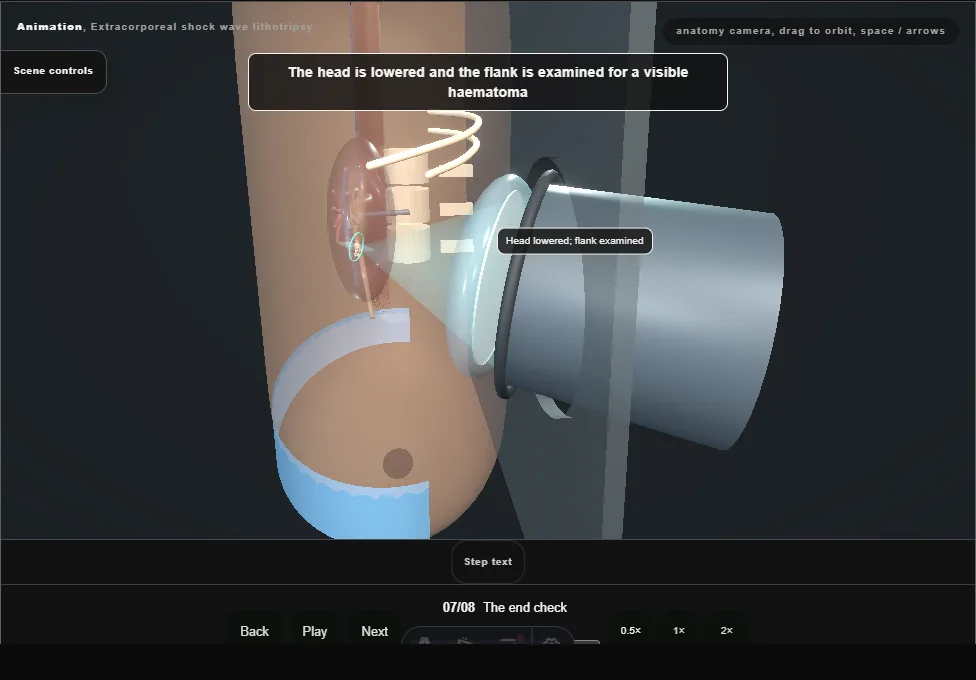 Extracorporeal shock wave lithotripsy. Step 7: The end check. Captured frame from the interactive animation.