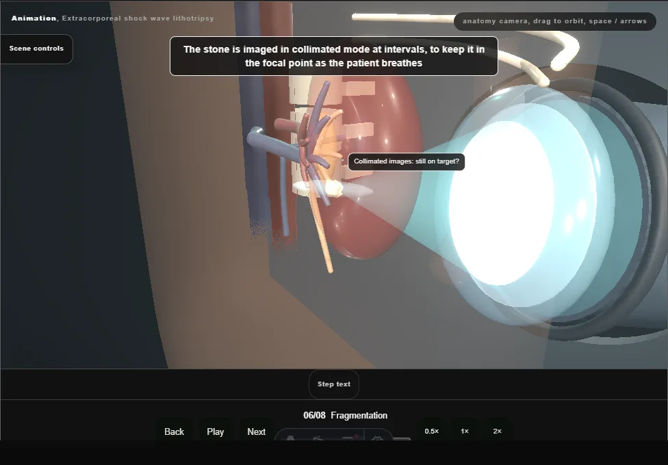 Extracorporeal shock wave lithotripsy. Step 6: Fragmentation. Captured frame from the interactive animation.