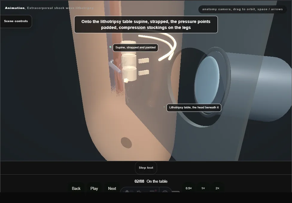 Extracorporeal shock wave lithotripsy. Step 2: On the table. Captured frame from the interactive animation.