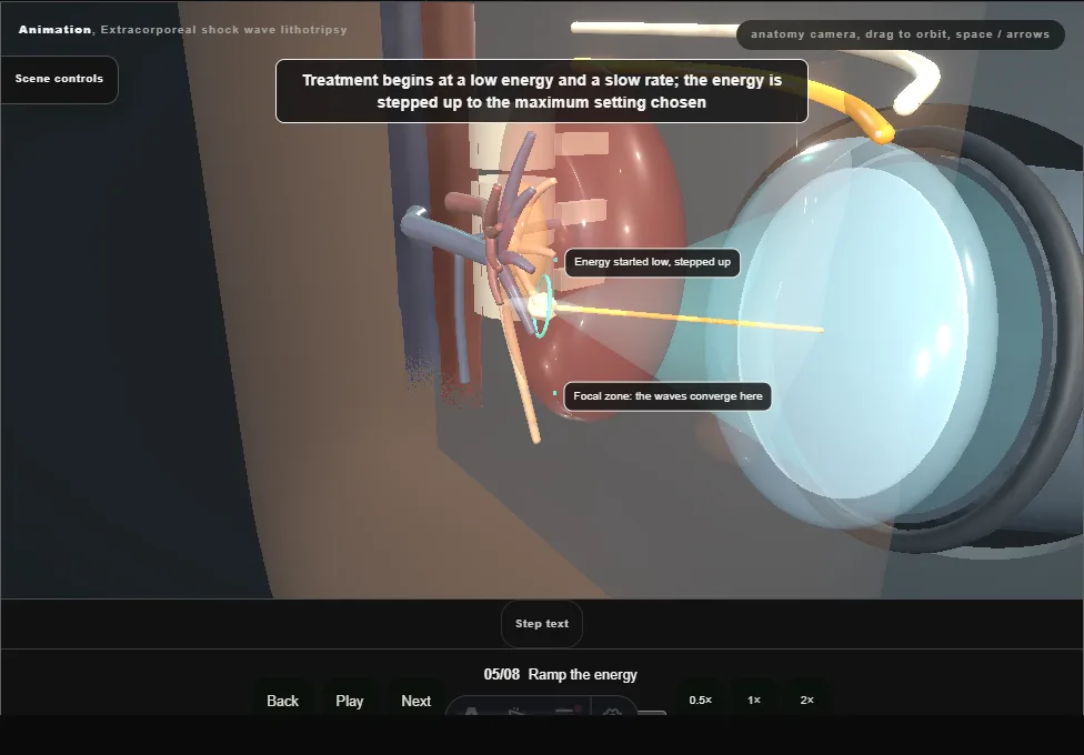 Extracorporeal shock wave lithotripsy. Step 5: Ramp the energy. Captured frame from the interactive animation.