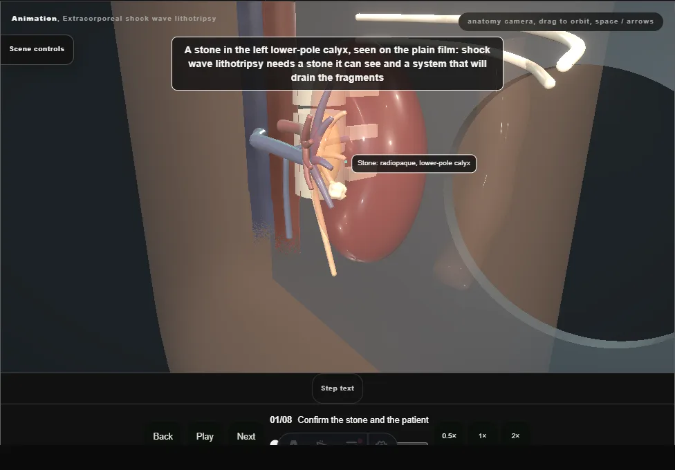 Extracorporeal shock wave lithotripsy. Step 1: Confirm the stone and the patient. Captured frame from the interactive animation.