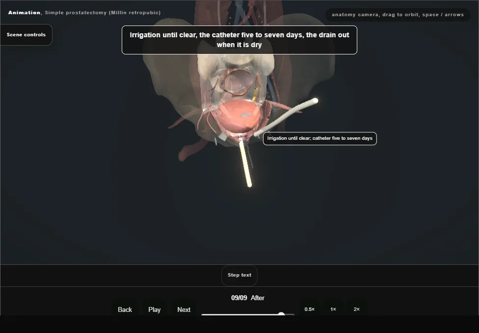 Simple prostatectomy (Millin retropubic). Step 9: After. Captured frame from the interactive animation.