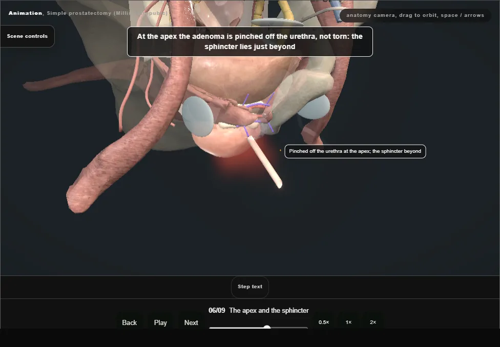 Simple prostatectomy (Millin retropubic). Step 6: The apex and the sphincter. Captured frame from the interactive animation.