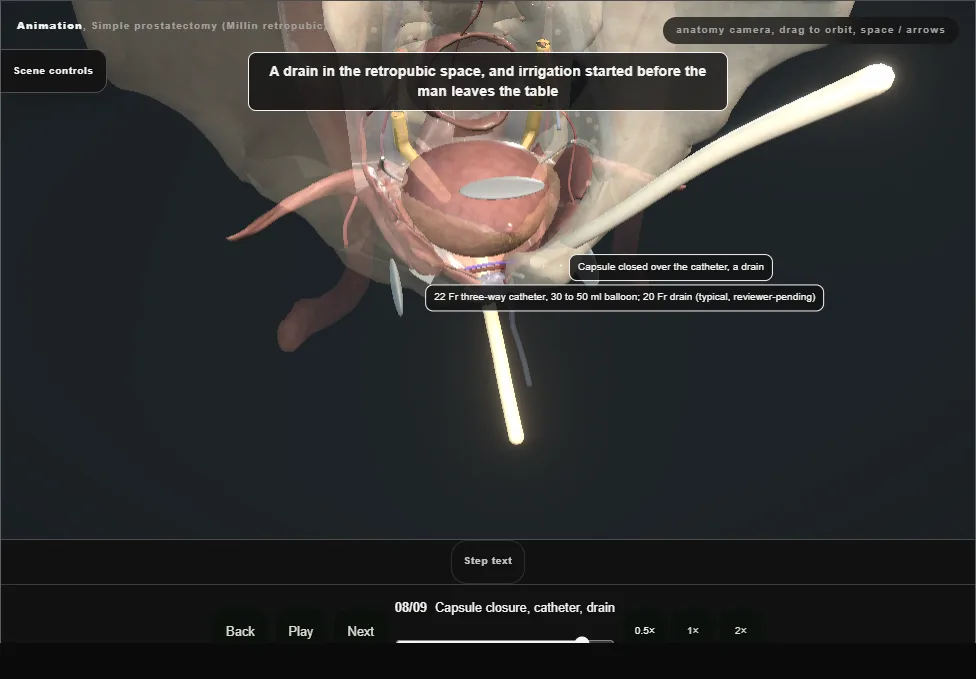Simple prostatectomy (Millin retropubic). Step 8: Capsule closure, catheter, drain. Captured frame from the interactive animation.
