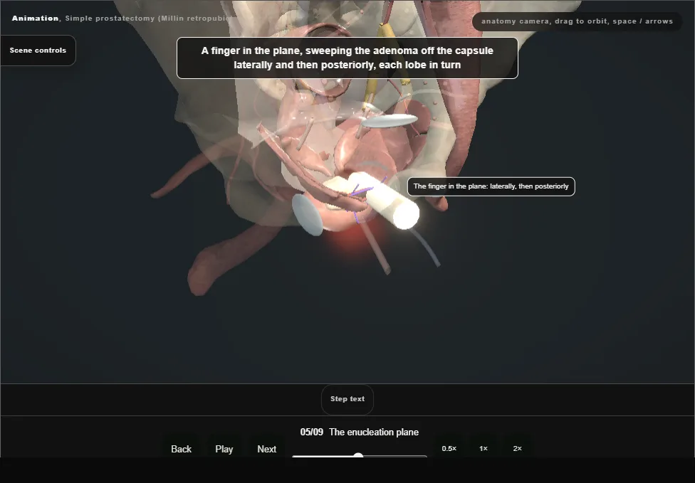 Simple prostatectomy (Millin retropubic). Step 5: The enucleation plane. Captured frame from the interactive animation.