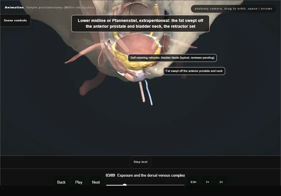 Simple prostatectomy (Millin retropubic). Step 3: Exposure and the dorsal venous complex. Captured frame from the interactive animation.