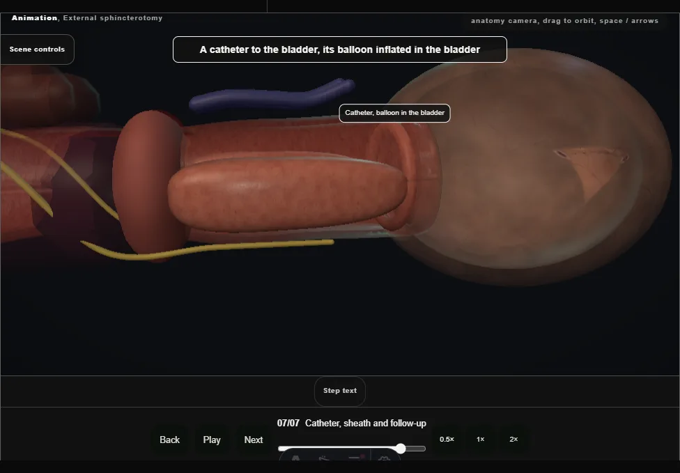 External sphincterotomy. Step 7: Catheter, sheath and follow-up. Captured frame from the interactive animation.