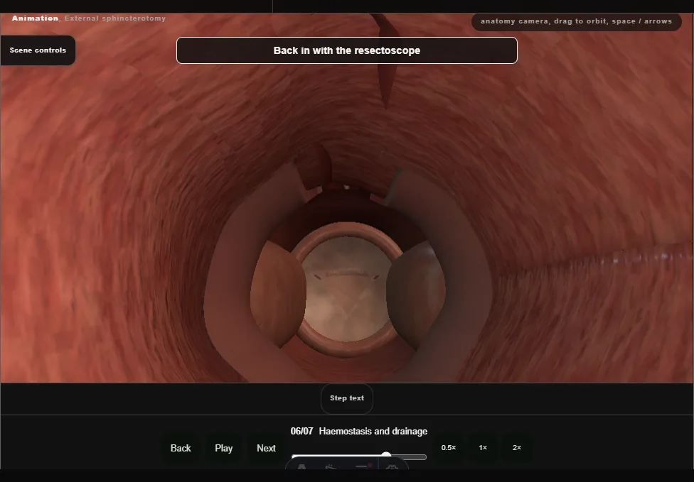 External sphincterotomy. Step 6: Haemostasis and drainage. Captured frame from the interactive animation.