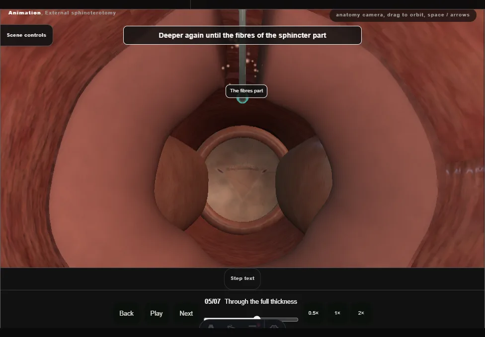 External sphincterotomy. Step 5: Through the full thickness. Captured frame from the interactive animation.