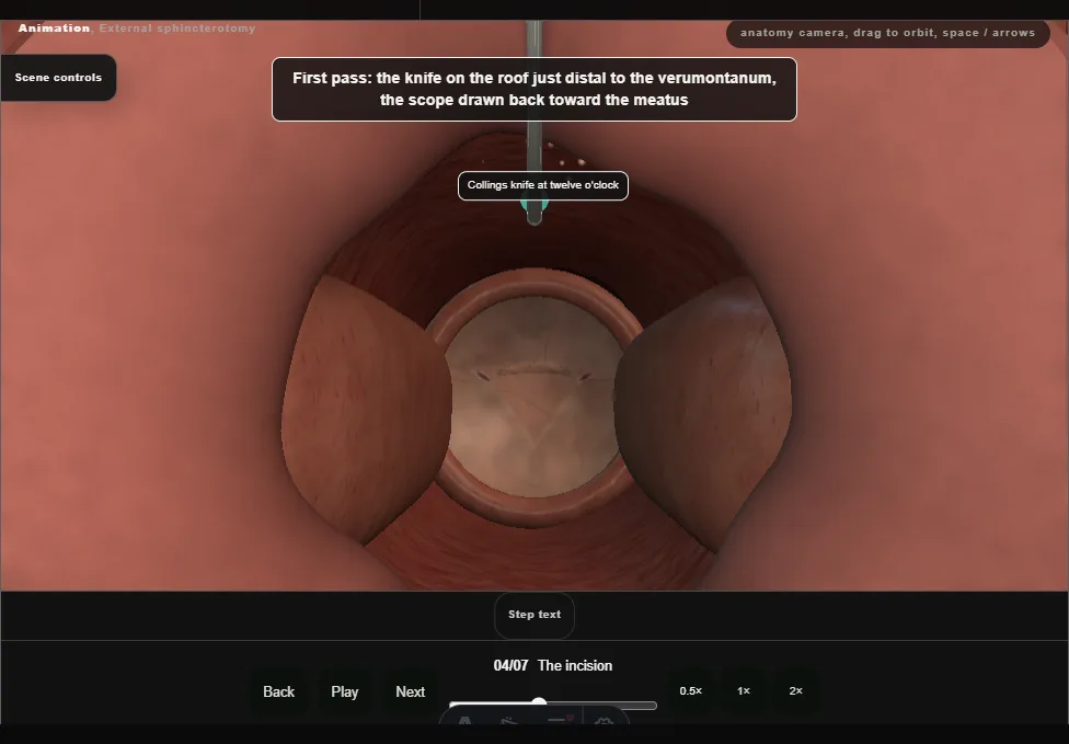 External sphincterotomy. Step 4: The incision. Captured frame from the interactive animation.