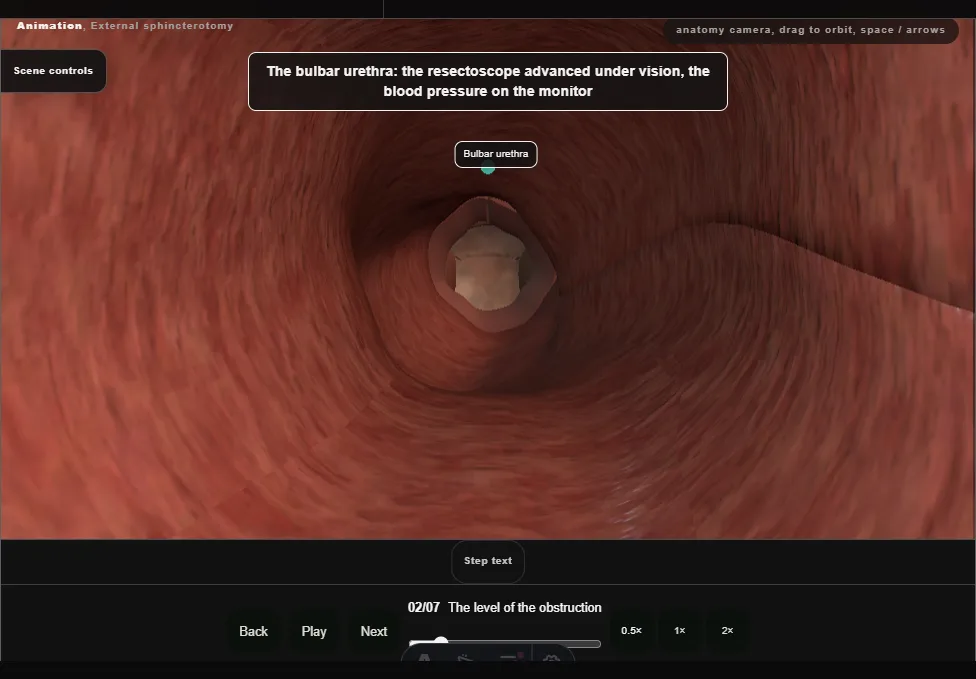 External sphincterotomy. Step 2: The level of the obstruction. Captured frame from the interactive animation.