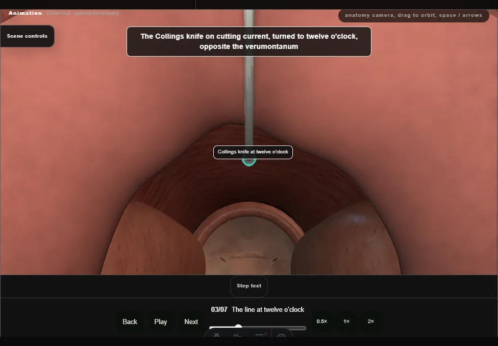 External sphincterotomy. Step 3: The line at twelve o'clock. Captured frame from the interactive animation.