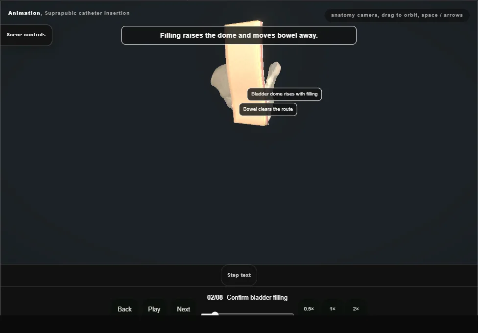 Suprapubic catheter insertion. Step 2: Confirm bladder filling. Captured frame from the interactive animation.
