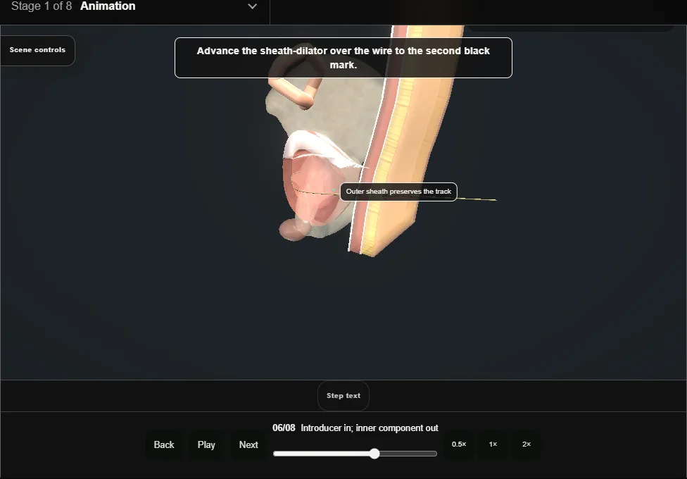 Suprapubic catheter insertion. Step 6: Introducer in; inner component out. Captured frame from the interactive animation.