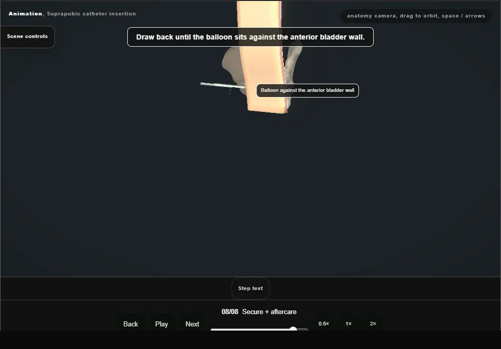 Suprapubic catheter insertion. Step 8: Secure + aftercare. Captured frame from the interactive animation.
