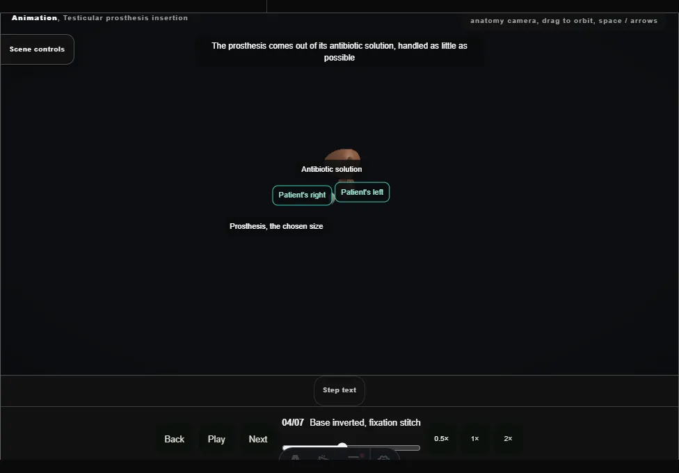 Testicular prosthesis insertion. Step 4: Base inverted, fixation stitch. Captured frame from the interactive animation.