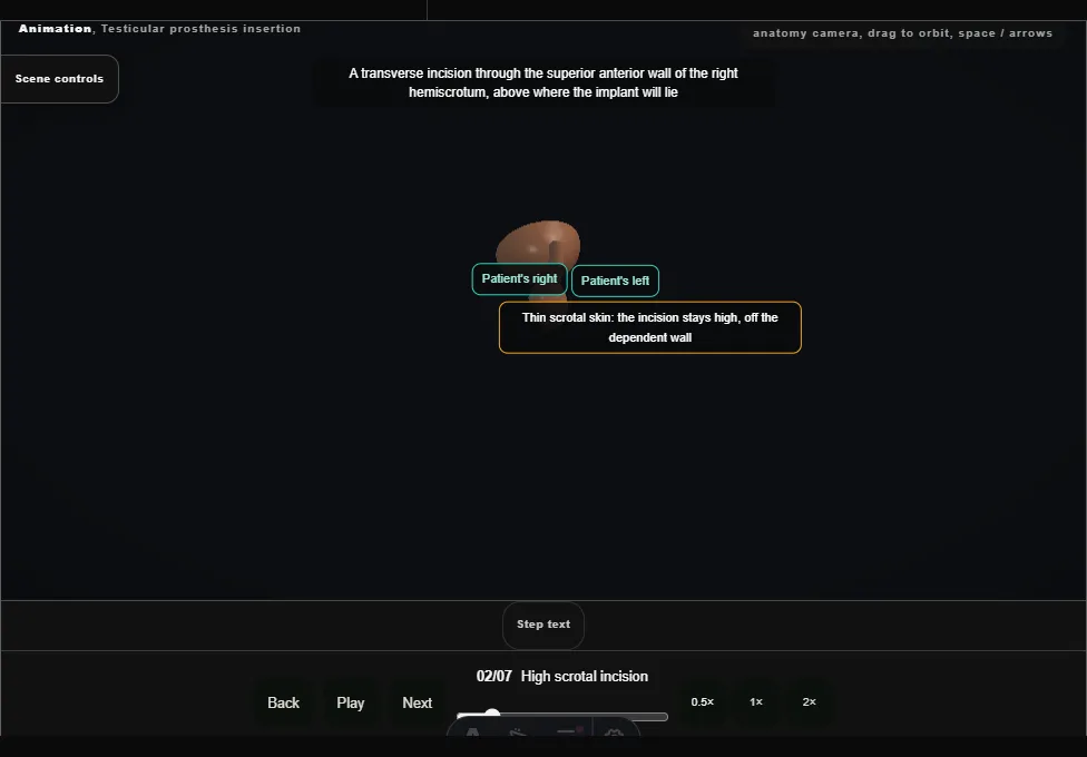 Testicular prosthesis insertion. Step 2: High scrotal incision. Captured frame from the interactive animation.