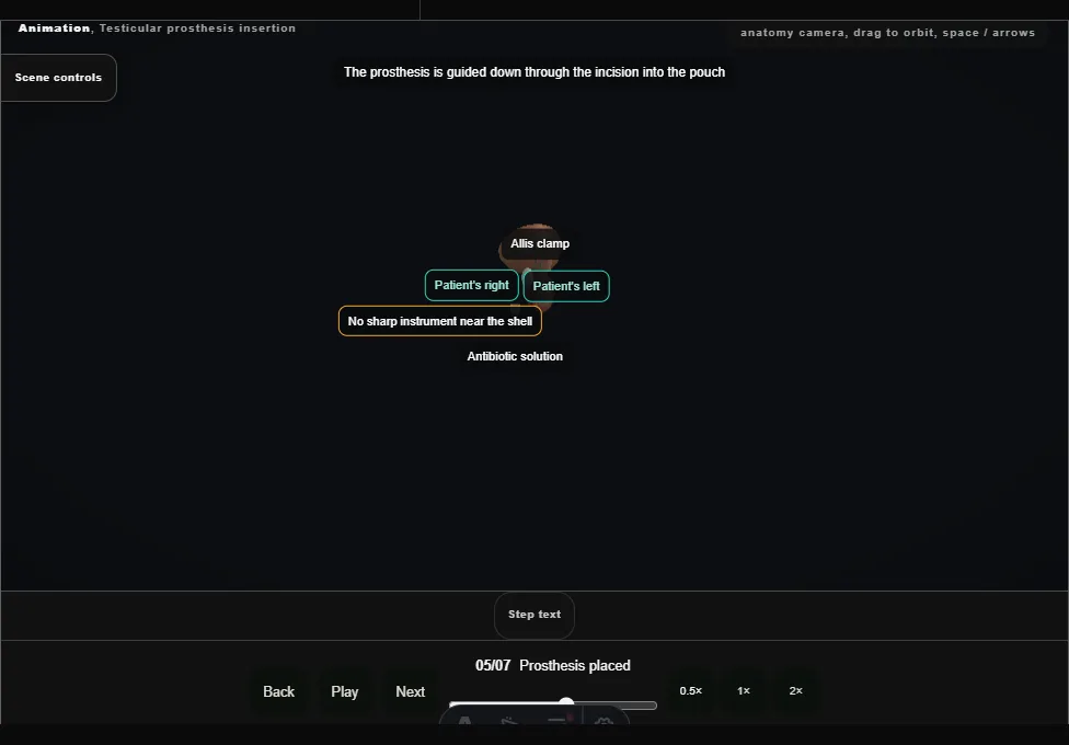 Testicular prosthesis insertion. Step 5: Prosthesis placed. Captured frame from the interactive animation.