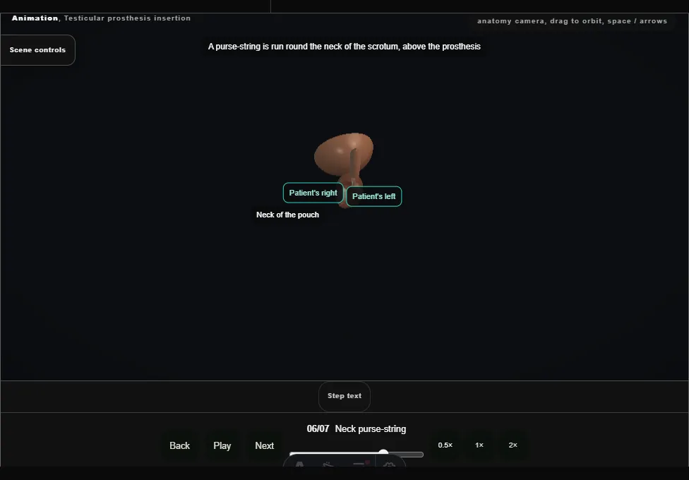 Testicular prosthesis insertion. Step 6: Neck purse-string. Captured frame from the interactive animation.
