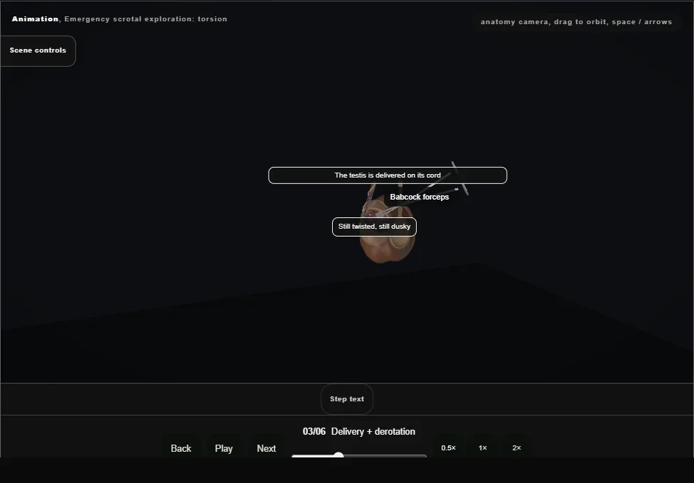 Emergency scrotal exploration: torsion. Step 3: Delivery + derotation. Captured frame from the interactive animation.