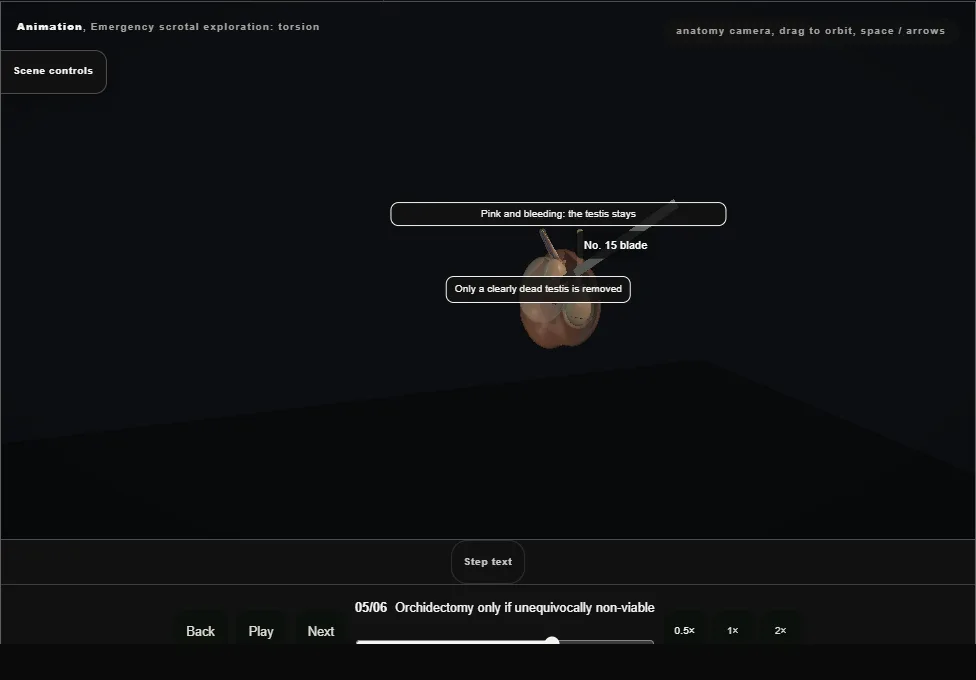 Emergency scrotal exploration: torsion. Step 5: Orchidectomy only if unequivocally non-viable. Captured frame from the interactive animation.