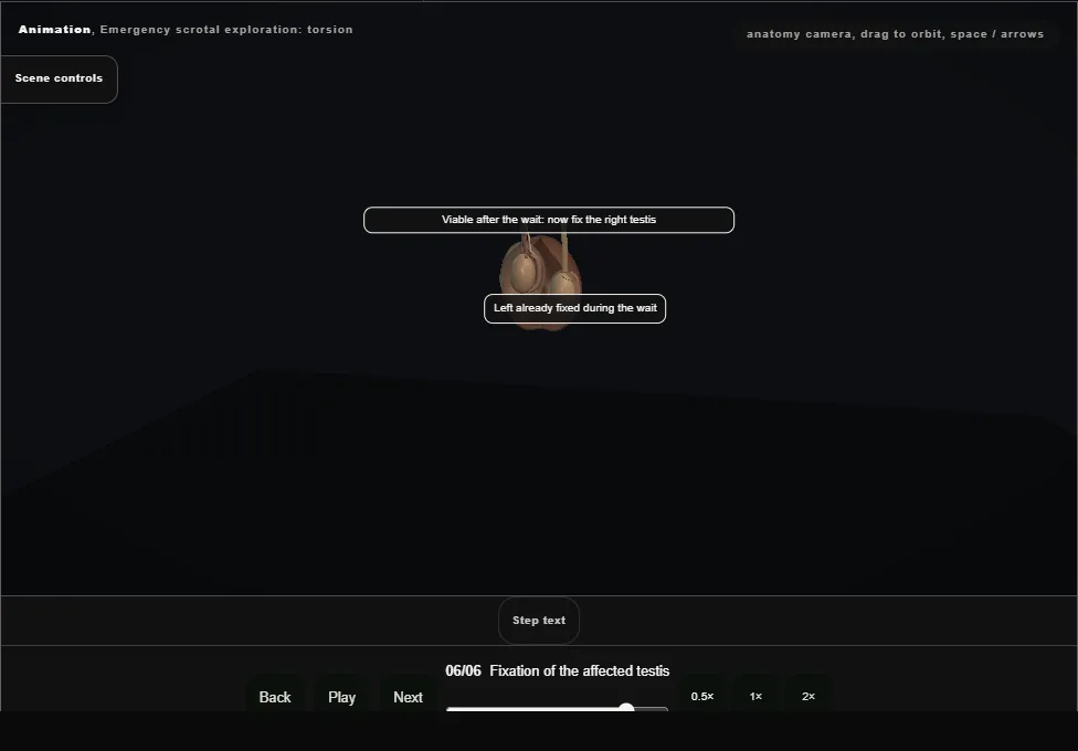 Emergency scrotal exploration: torsion. Step 6: Fixation of the affected testis. Captured frame from the interactive animation.
