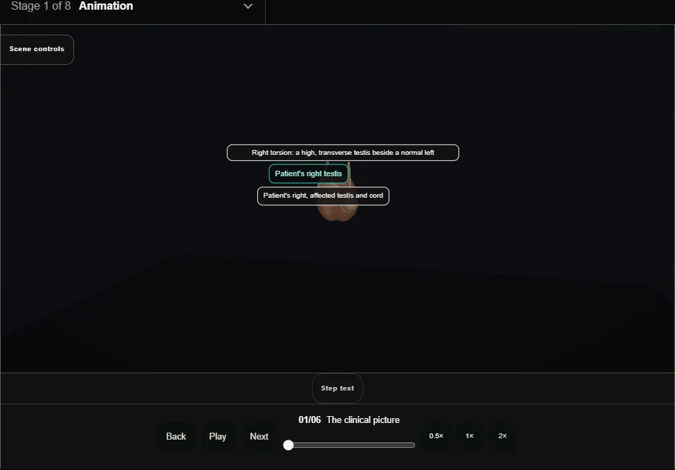 Emergency scrotal exploration: torsion. Step 1: The clinical picture. Captured frame from the interactive animation.